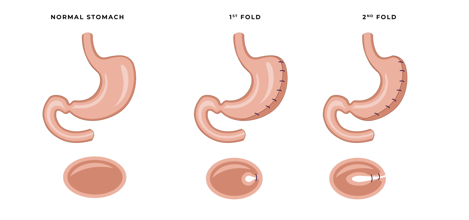 Bariatric Surgery: Not the Easy Way Out | Dallas Fort Worth