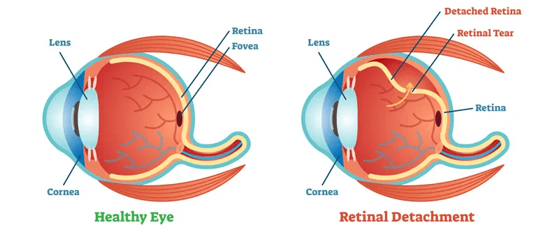 Retinal-surgery